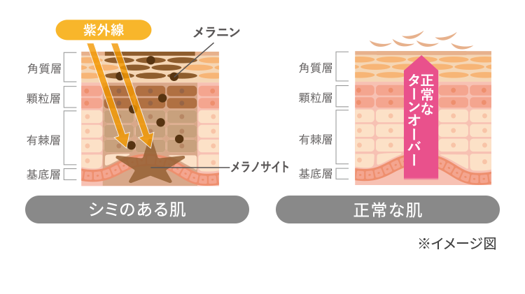 シミのある肌 正常な肌